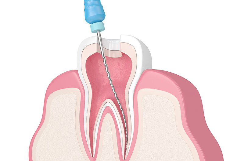 根管治療とは