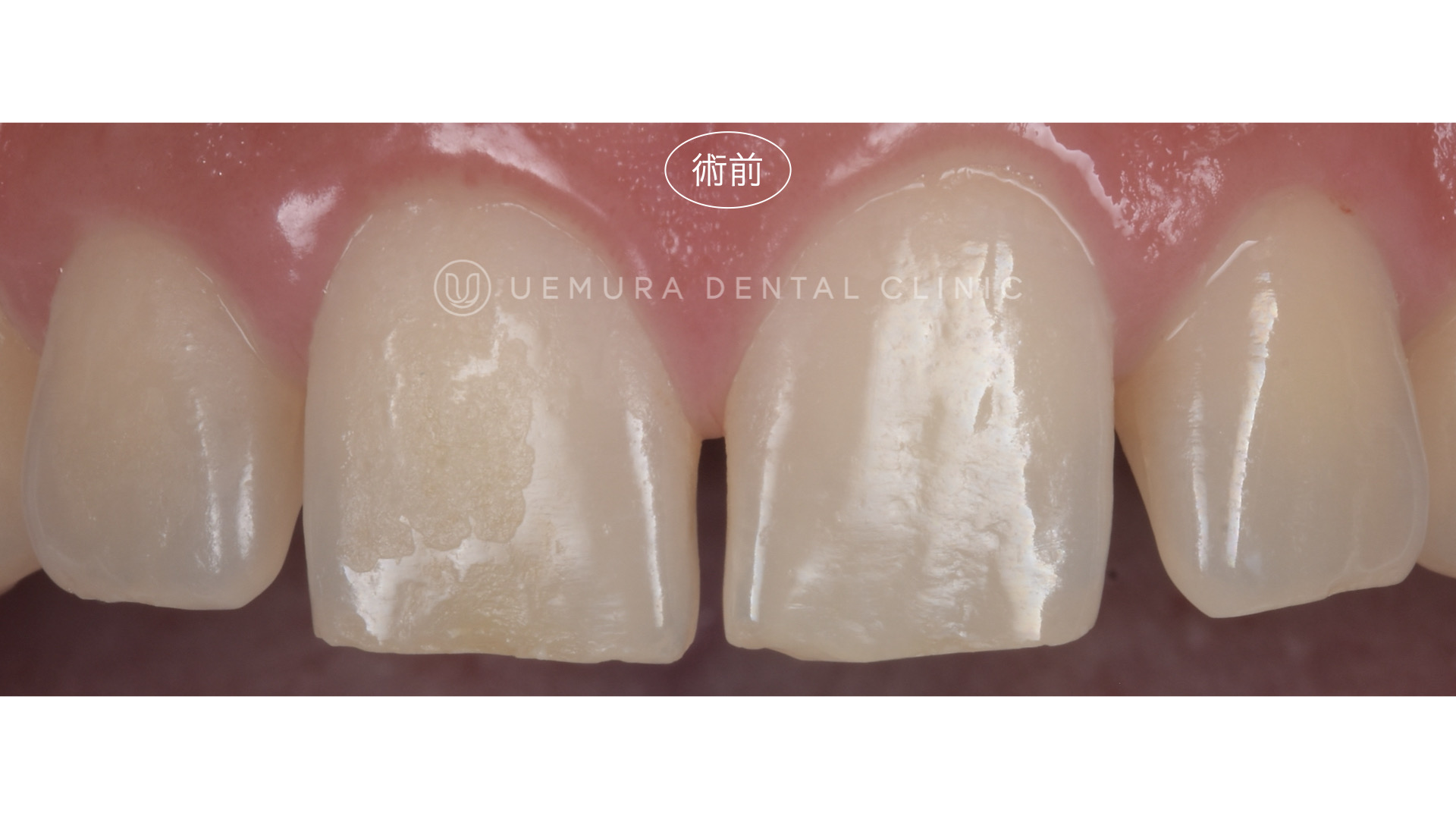 精密・丁寧な治療。長持ちさせるためのダイレクトボンディング