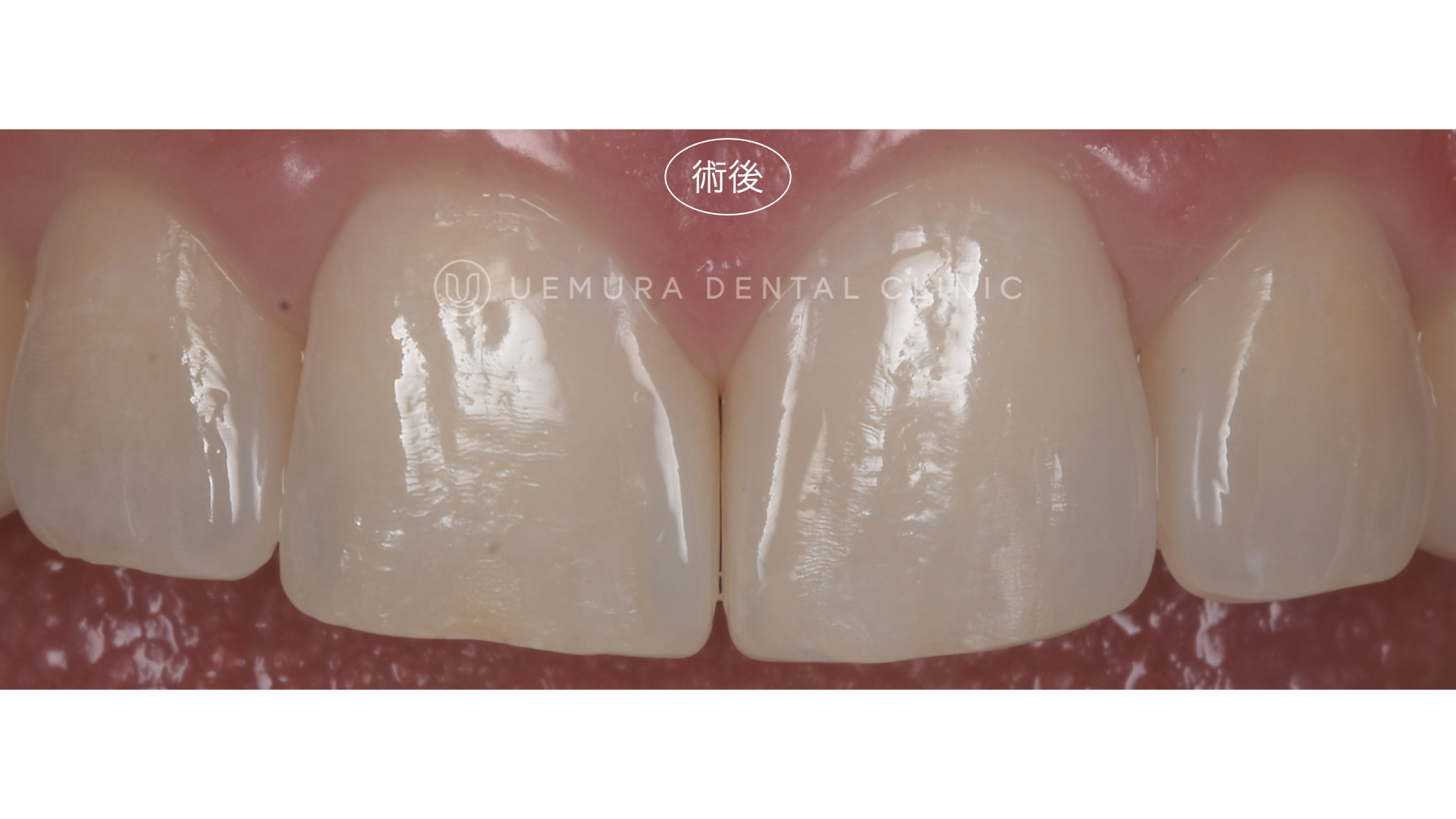 精密・丁寧な治療。長持ちさせるためのダイレクトボンディング